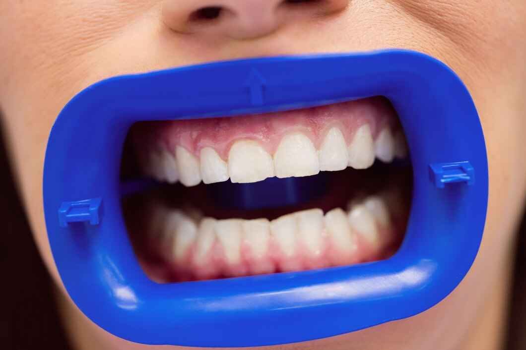 Whiter Teeth